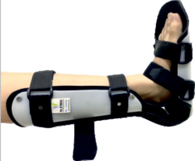IGR Derotation Bar with Traction