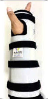 IGR Forearm Splint (Corset)