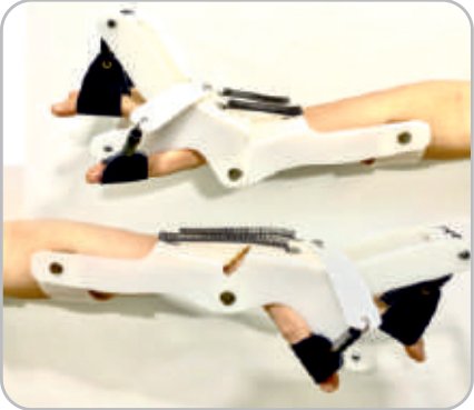 IGR Dynamic Radial Palsy with Finger Thumb Attachment