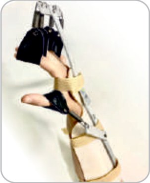 IGR Palsy Splint (Fix Wrist)