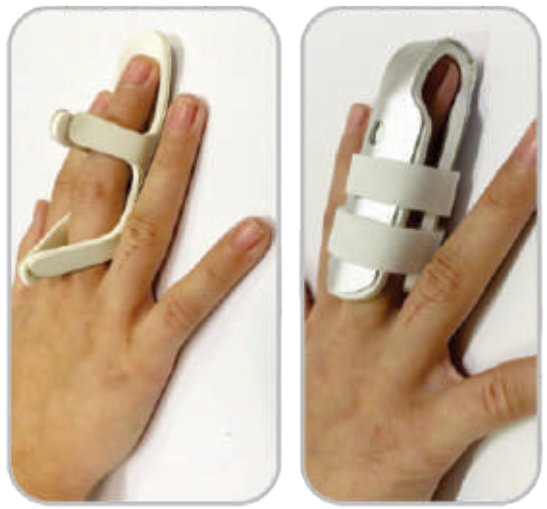 IGR Cot Splint